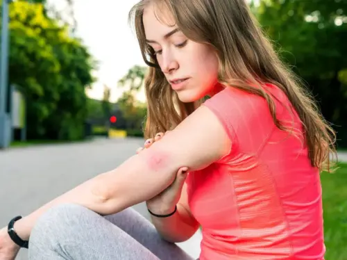 young woman with insect sting on her arm
